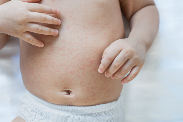 蹒跚学步的婴儿在身上刮出水痘疹。儿童红疹过敏。关闭发烧疹子。图片下载