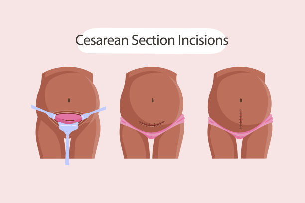 手绘平面设计剖宫产剖宫产矢量插图图片下载