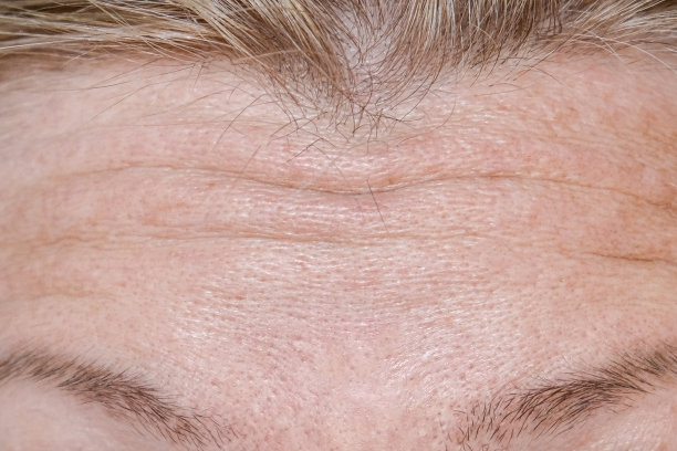 女性在进行返老还嫩手术、注射、治疗、手术前，额头上有皱纹图片下载