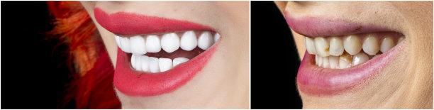 全口康复由冠饰面和种植体完成图片下载