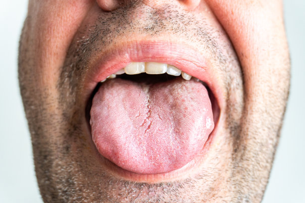 男性裂纹舌头的特写。图片下载