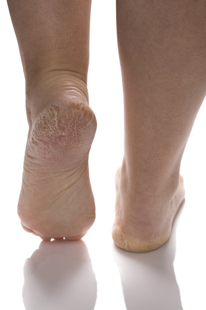 脚跟干裂的图片下载