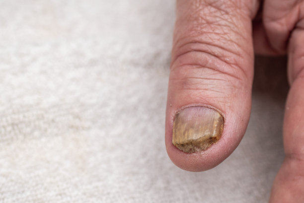 大指甲真菌感染。指甲真菌感染，手，手指，指甲真菌病。特写。图片下载