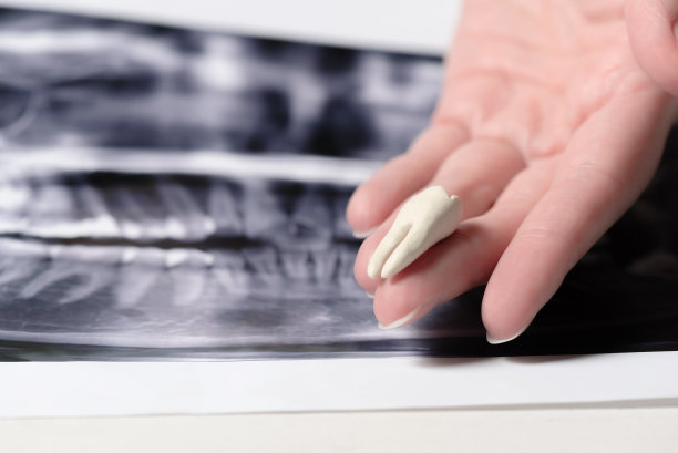 牙齿全景x光片图片下载