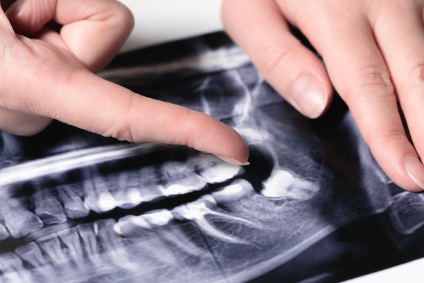 牙齿全景x光片图片下载