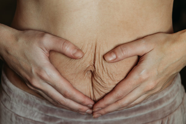 年轻女子怀孕后肚子上满是妊娠纹。图片下载