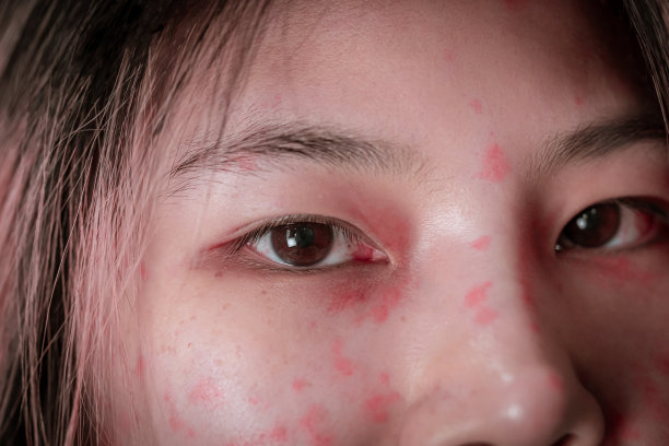 亚洲妇女遭受皮肤过敏从化妆品和化妆品使她的皮肤红，痒和痛苦。闭上眼睛图片下载