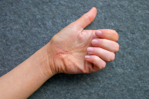 一只受伤的手的特写图片下载