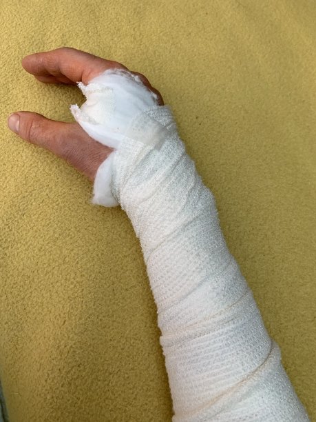 缠着绷带的手臂图片下载