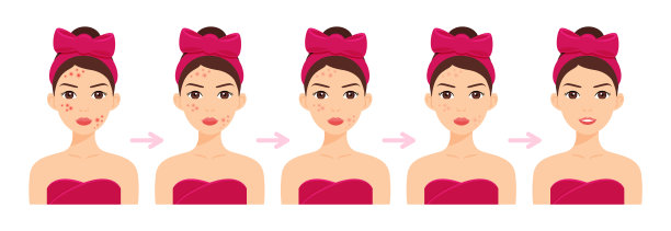 可爱的女人脸上有粉刺。痤疮治疗。步骤。面部皮肤美白。阶段。快乐女孩的微笑和清洁的皮肤。卡通风格。白色背景。矢量插图的美设计。图片下载