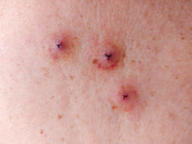 人类皮肤被水蛭咬伤图片下载