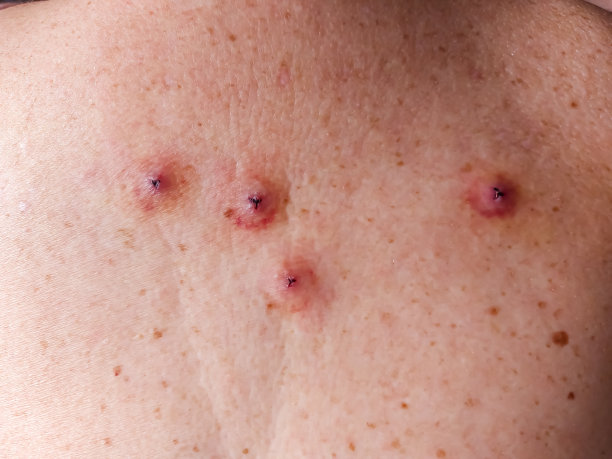 人类皮肤被水蛭咬伤图片下载