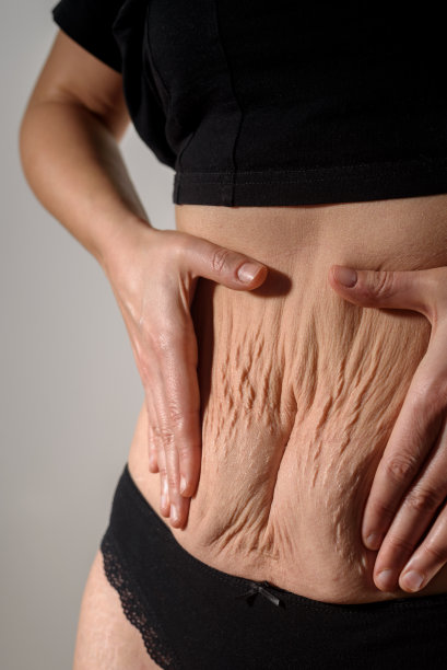 肚子上有妊娠纹和伤疤的女人图片下载