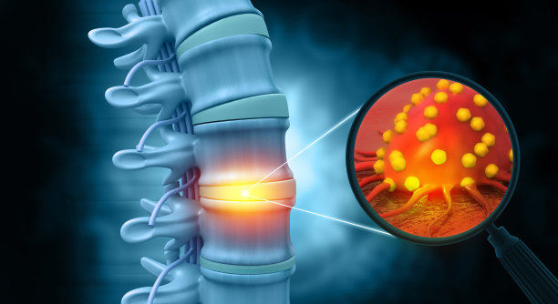 脊柱癌症或脊柱肿瘤疾病。三维演示图片下载