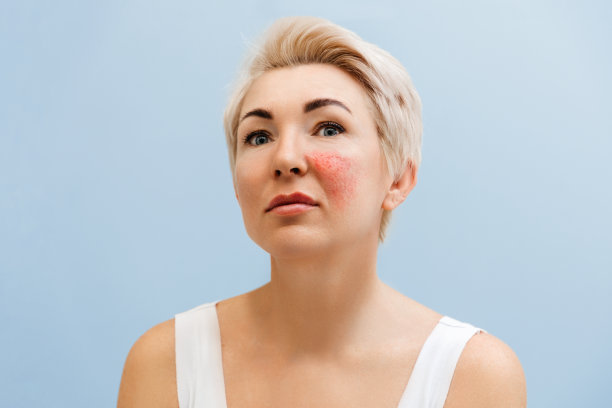 成年金发女人的肖像与酒渣鼻在她的脸颊。couperose和美容的概念图片下载