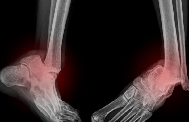 脚踝错位图片下载