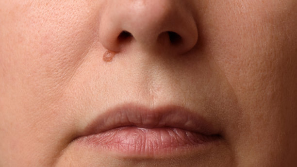 女性面部鼻子下的痣或痣的特写。及时诊断的概念。图片下载