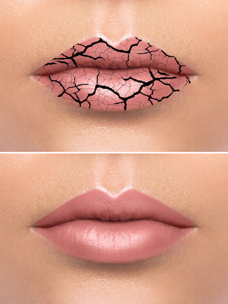治疗后女性嘴唇干裂图片下载