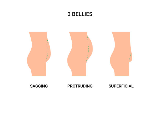 人的腹部类型，大肚子与超重。下垂，突出和浅表的肚子。减肥，减腹，手术整形手术。矢量图图片下载