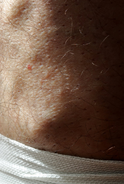 静脉曲张压迫袜。治疗静脉曲张的药物图片下载