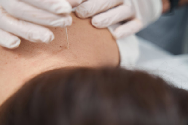 针灸放松肌肉的特写照片图片下载