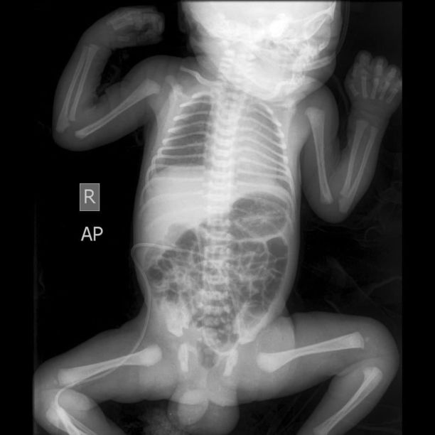 Babygram x光图像图片下载