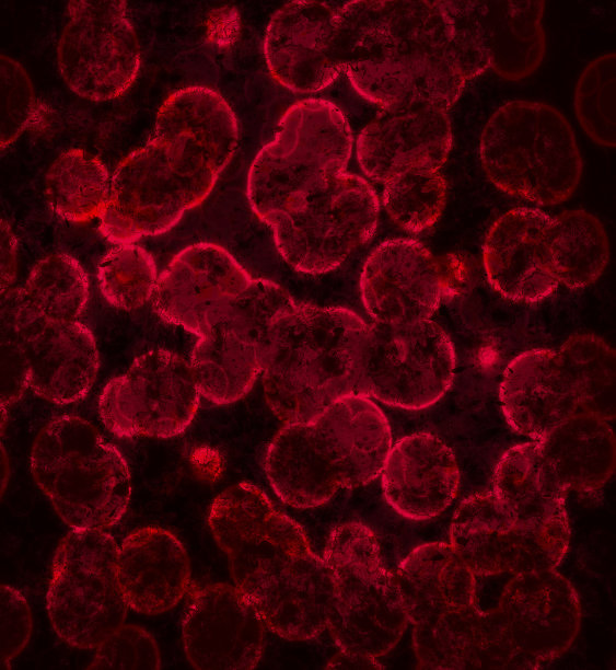 血液感染特写。显微镜下的感染细胞。血液中的病毒图片下载