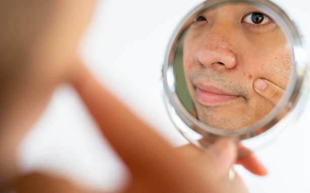 裁剪照片的亚洲男子看到了粉刺或痤疮的问题在他的脸通过一个小镜子。图片下载