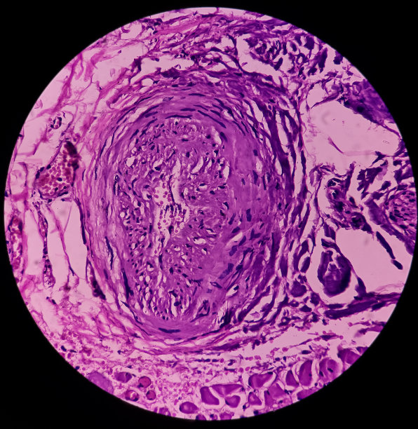 瘘道(活检):瘘道内衬肉芽组织，有密集浸润的异型细胞、淋巴细胞、组织细胞和巨细胞。图片下载