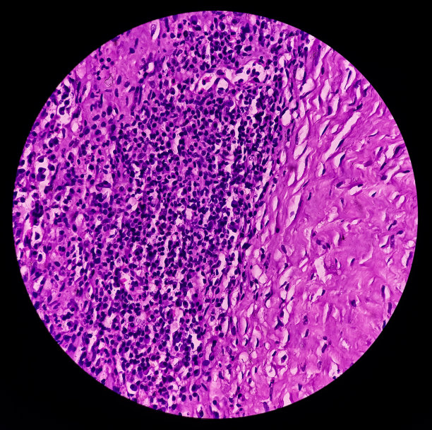 瘘道(活检):瘘道内衬肉芽组织，有密集浸润的异型细胞、淋巴细胞、组织细胞和巨细胞。图片下载