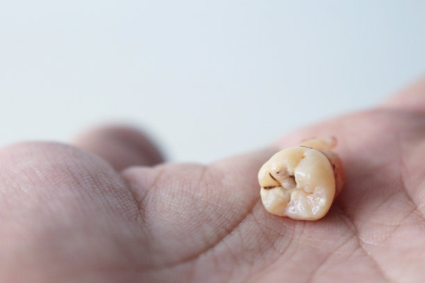 已经拔掉的蛀牙。图片下载