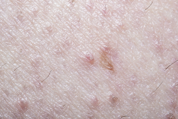 这是一个男人皮肤内长毛损伤的特写。高倍软聚焦的医学和皮肤病主题照片。图片下载