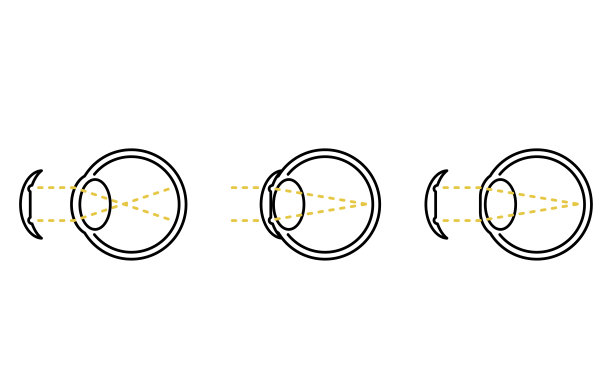 视力矫正镜和角膜塑形镜的工作原理(无正文)图片下载