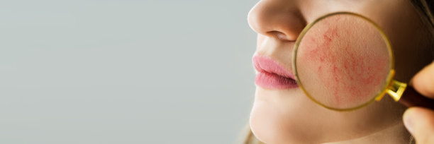 检查有酒渣鼻问题的面部皮肤图片下载