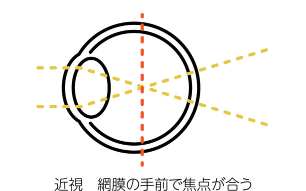 视力和屈光不正的医学插图，近视(聚焦在视网膜前)图片下载