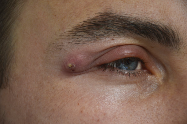 疖子——男人眼睛附近的一种强烈的脓性脓肿图片下载