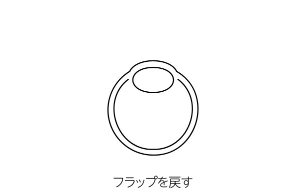 LASIK和屈光手术的医学插图图片下载