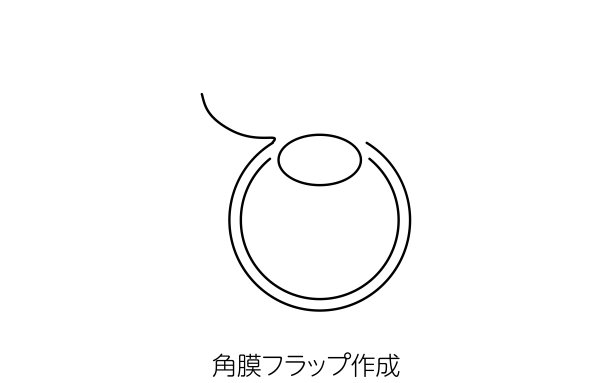 LASIK和屈光手术的医学插图图片下载