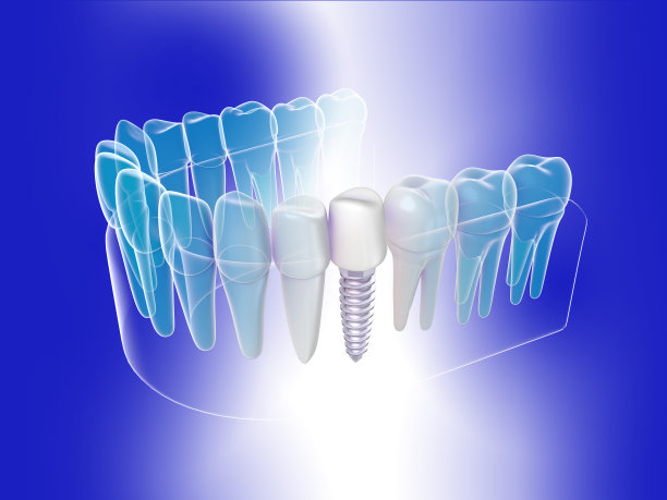 三维插图图形，等距式种植牙。图片下载