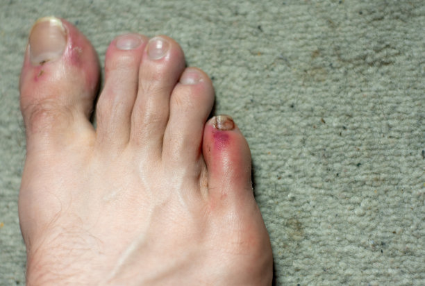 小脚趾被撞伤了图片下载