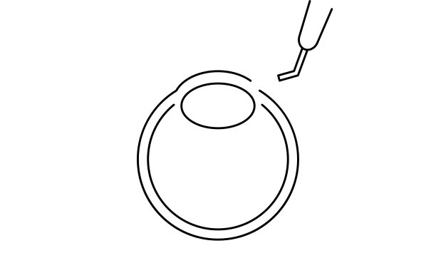 白内障手术过程，插图(画线)，切口图片下载