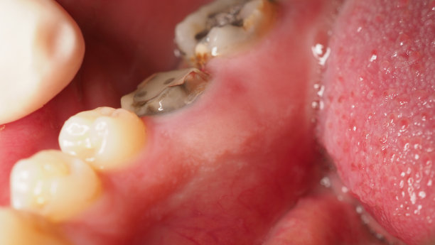 蛀牙根管治疗。下臼齿的牙齿或蛀牙。复合充填修复。成人龋齿。坏的牙齿。牙科临时修复材料。牙科的概念。关闭了。图片下载