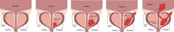 前列腺癌四个阶段的医学图表。肿瘤生长并渗入邻近的器官和组织。图片下载