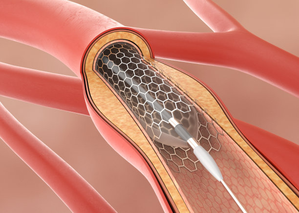 血液循环的支架植入图片下载