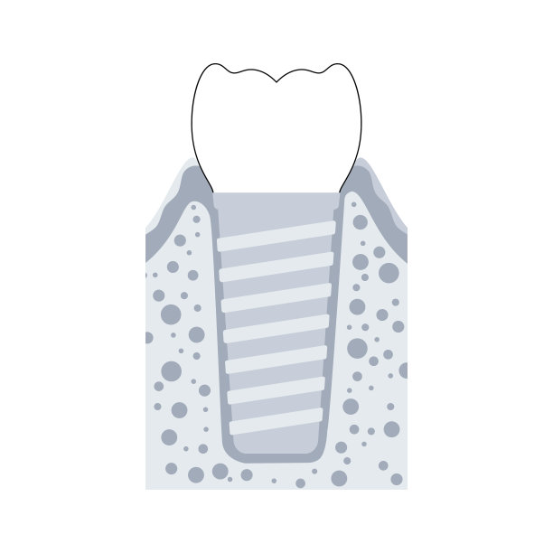 牙科植体手术图片下载