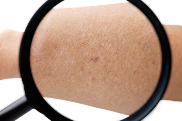 高级男性手臂皮肤有白色和棕色小斑点(特发性点滴性黑素减退症)。孤立在白色背景。图片下载