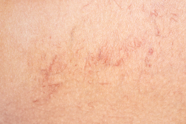 去除腿部的静脉曲张。毛细血管扩张症的医学检查和治疗。Phlebeurysm。图片下载