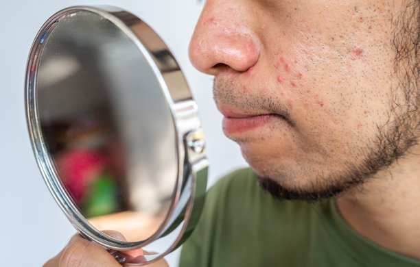 一名亚洲男子通过迷你镜子看到自己脸上的青春痘问题。图片下载