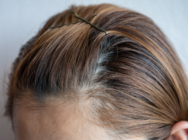裁剪的观点，妇女顶部的头与她的部分稀薄的头发，她有脱发的问题。图片下载