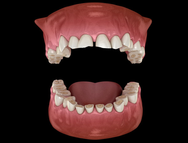 牙齿磨损(磨牙症)导致牙齿组织脱落。牙齿三维演示图片下载